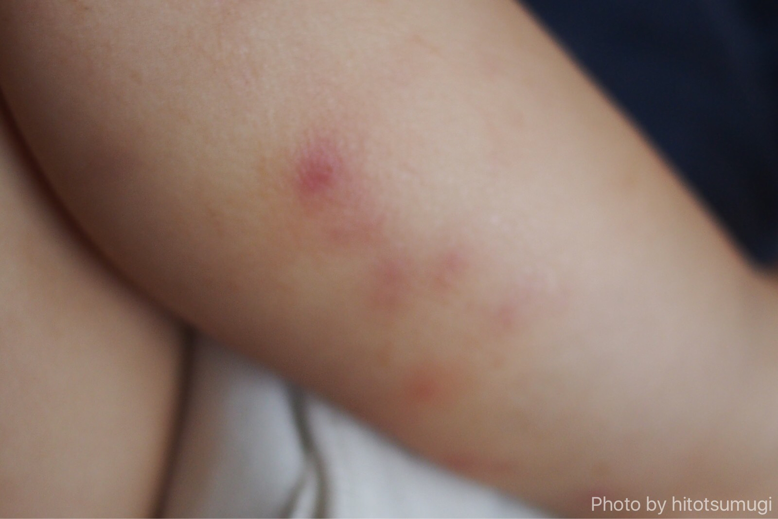 ［画像あり］ 1歳の子どもの湿疹で皮膚科を受診！「毛包炎（毛嚢炎）」の診断を受けました